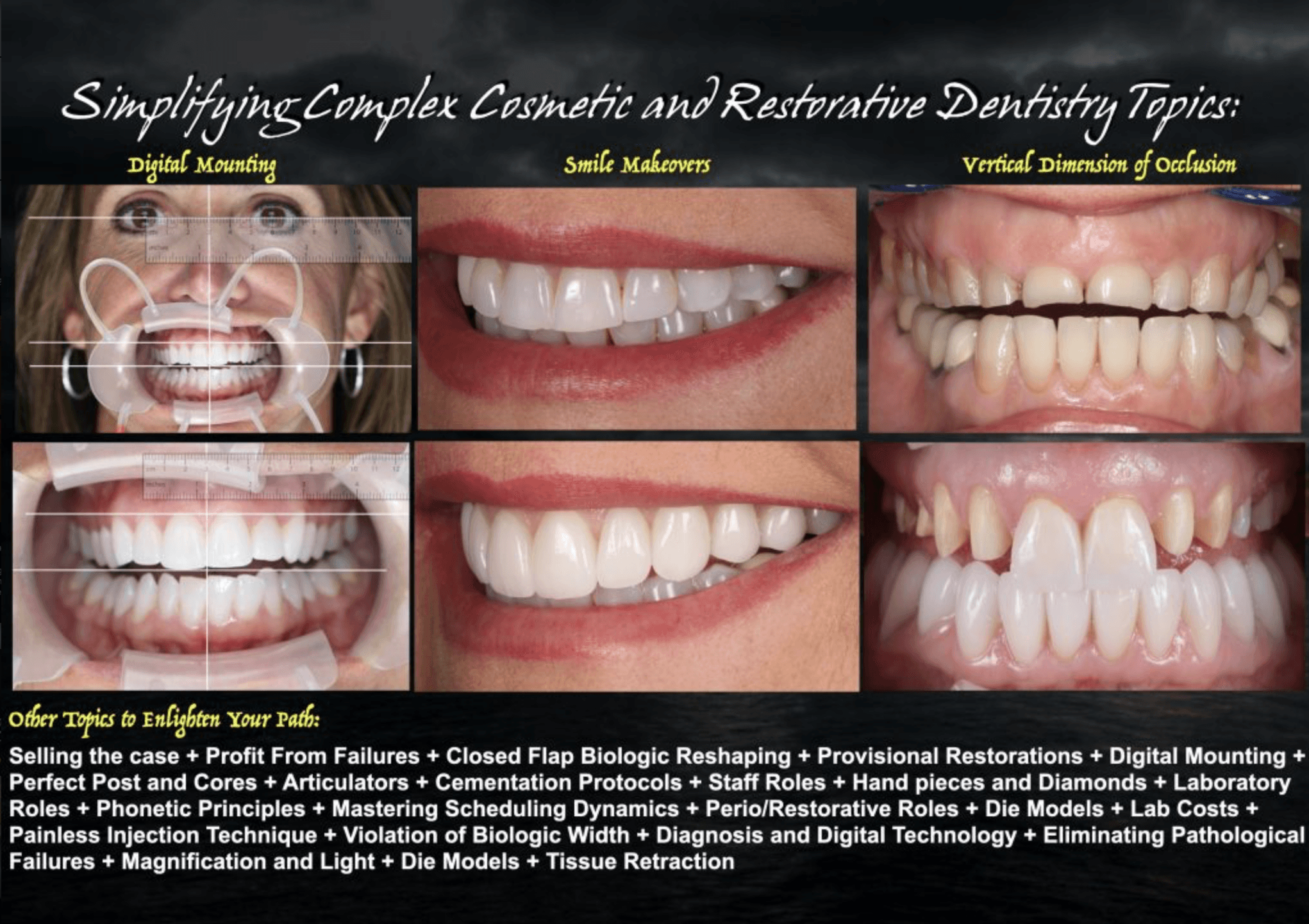 Cosmetic veneer and smile-makeover cases with opened vertical dimension — Strupp & Brumm clinical archive